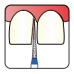 Osung Crown Anterior/ Proximal Cutting, Lingual Reduction Straight FG Shank 164-14F2 (160TC-21F) Fine Grit Diamond Bur 5/PK